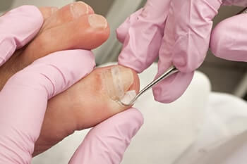 Ingrown toenails treatment in the Midtown & Downtown Manhattan: New York, NY 10038 and New York, NY 10036 as well as Forest Hills, NY 11375 area