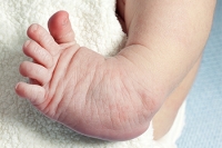 Dealing With Clubfoot in Babies